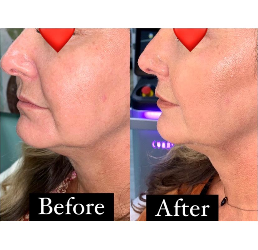 Fillers Before and After | Progressive Aesthetics
