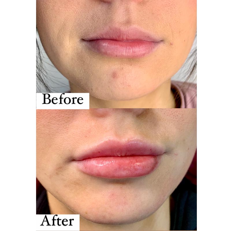 Fillers Before and After | Progressive Aesthetics