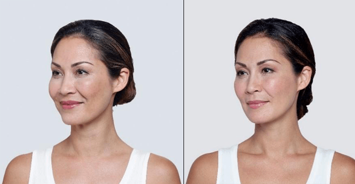 Restylane Before and After | Progressive Aesthetics