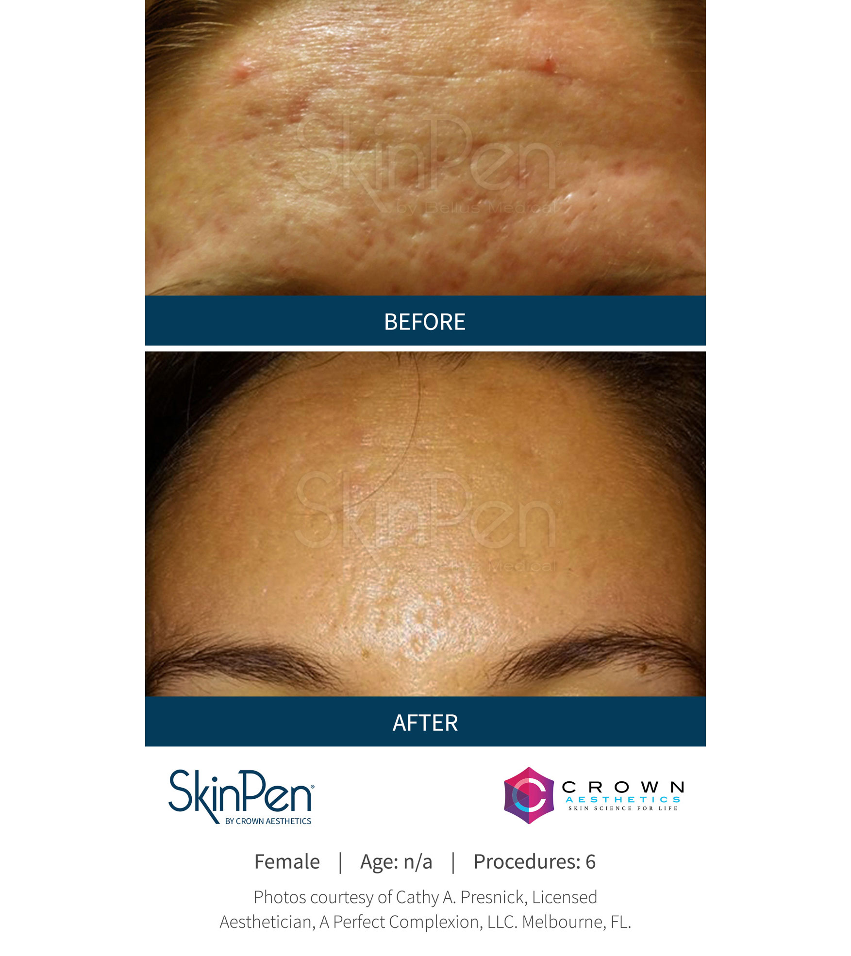 SkinPen Before and After | Progressive Aesthetics