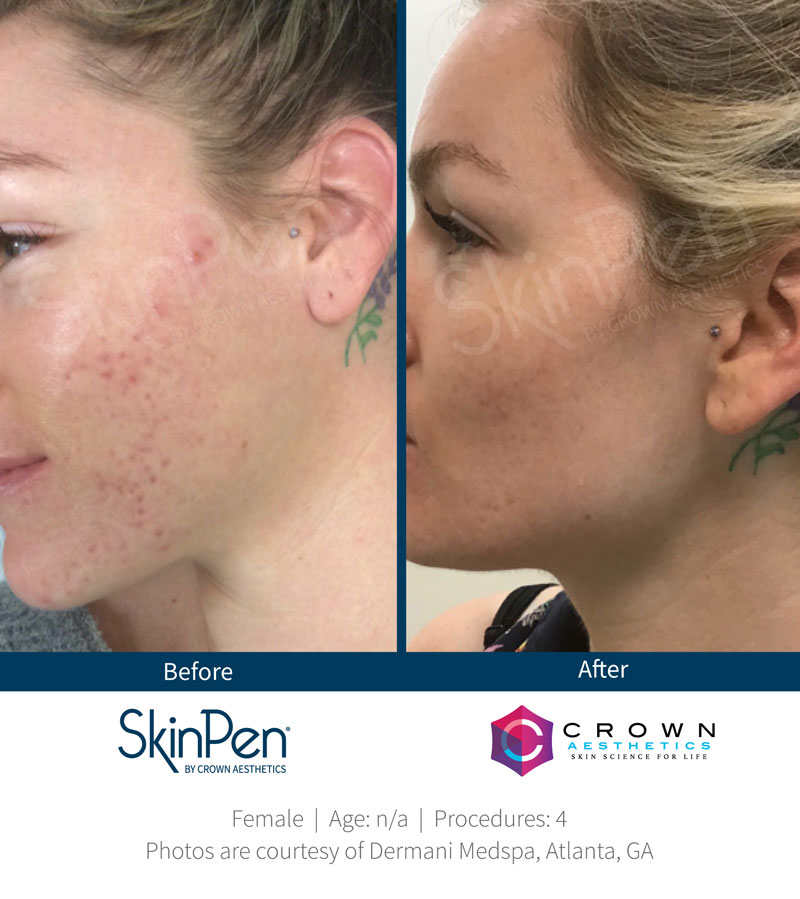 SkinPen Before and After | Progressive Aesthetics